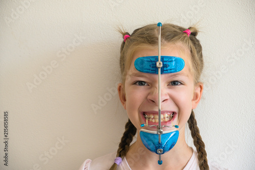 Obraz na plátně Cute girl making funny face wearing orthodontic protraction facemask and braces