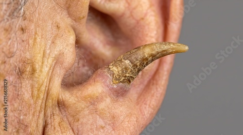 Macro photograph of cutaneous horn keratotic growth on elderly human ear lesion