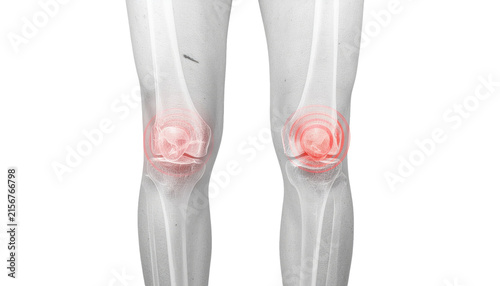 Medical Illustration of Inflamed Knee Joints Showing Arthritis Pain and Joint Inflammation on transparent background