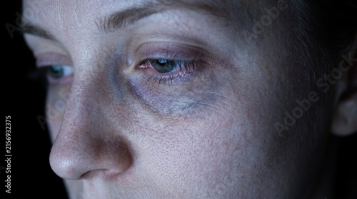 Cinematic dramatic closeup of woman eye showing dark periorbital circles and tired under eye bags
