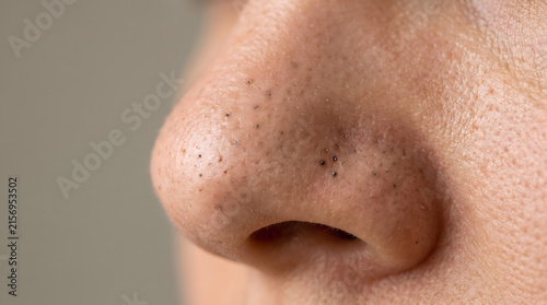Human nose showing visible blackheads and enlarged pores in a sharp close up macro photography style shot with bright lighting