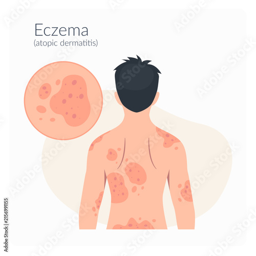 Skin Rashes Eczema atopic dermatitis on back- Stock Illustration as SVG File