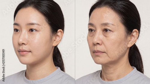 Face aging progression comparison showing young and elderly Asian woman with wrinkles and skin laxity