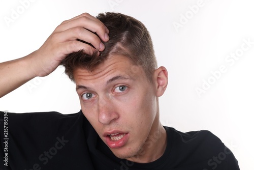 Fotografía Dandruff problem