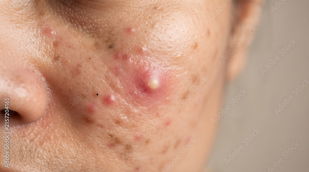 Fototapeta premium Close up view of skin with inflammatory acne and pustules showing redness and clogged pores on cheek area during dermatology examination for medical skincare treatment.