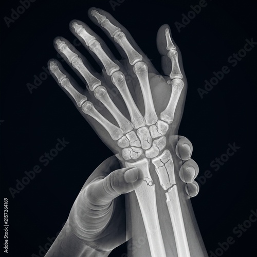 Obraz na plátně X-Ray Illustration of Broken Human Wrist Bone with Hand Holding Painful Joint Fr