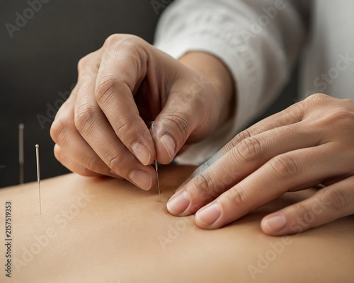 Acupuncturist inserting fine sterile needles into patient's skin