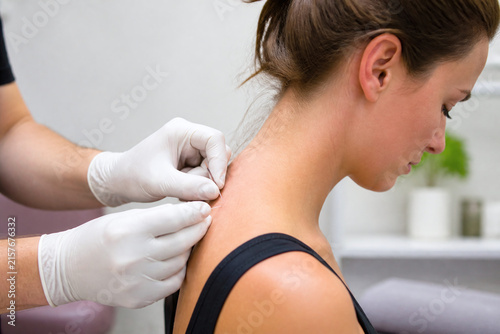 Dry needling therapy on neck and shoulder