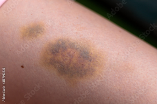 Severe contusion with skin discoloration on thigh area