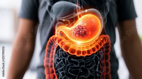 Human digestive system illustration showing glowing stomach with gastric tumor, highlighting cancer and disease
