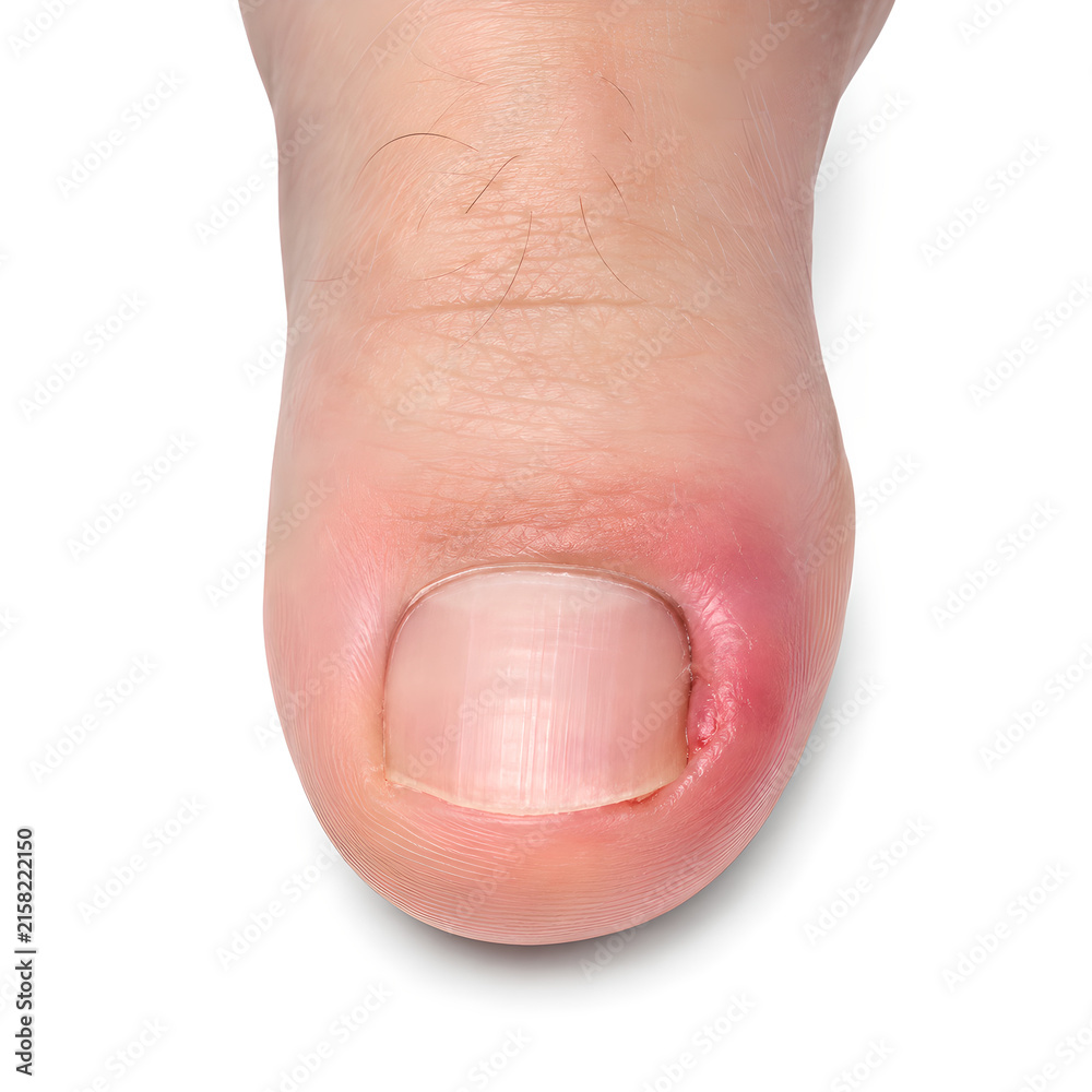 Fototapeta premium Ingrown toenail medical 3D anatomy render showing inflamed big toe nail margin with redness and swelling, isolated on white background for healthcare, podiatry, medical education and patient education