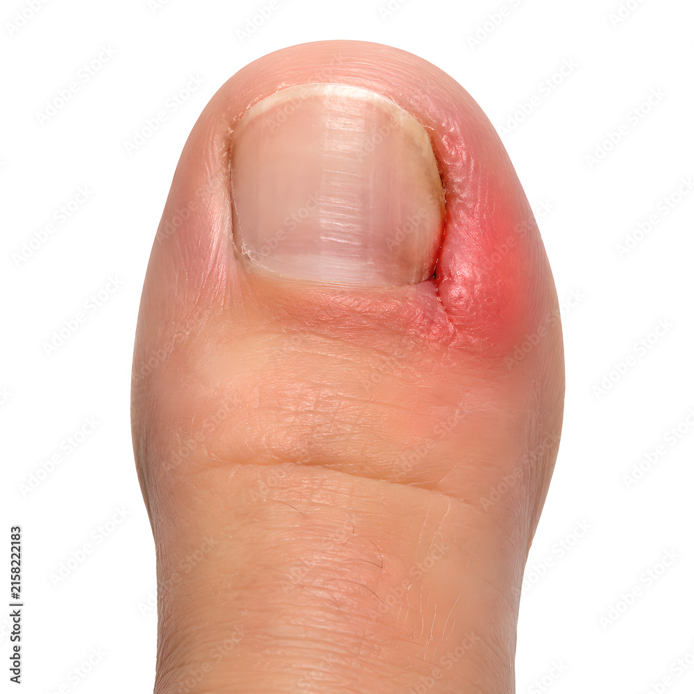 Fototapeta premium Ingrown toenail medical 3D anatomy render showing inflamed big toe nail margin with redness and swelling, isolated on white background for healthcare, podiatry, medical education and patient education