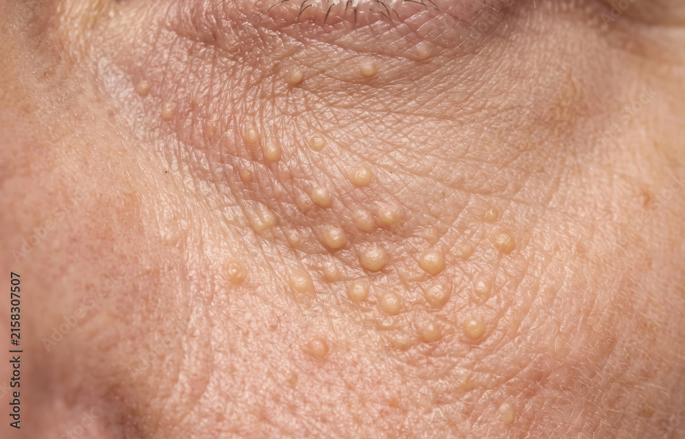 Fototapeta premium Dense multiple eruptive syringoma nodules and milia cysts on the periorbital and lower eyelid skin