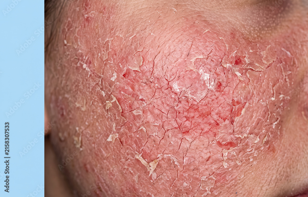 Fototapeta premium Severe facial eczema with extensive erythema skin cracking and dry peeling flakes on human cheek