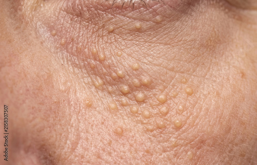 Dense multiple eruptive syringoma nodules and milia cysts on the periorbital and lower eyelid skin