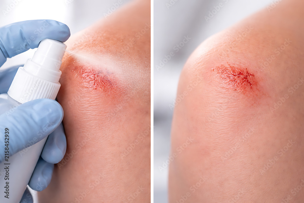Fototapeta premium Antiseptic spray treatment for minor knee abrasion in clinical first aid care