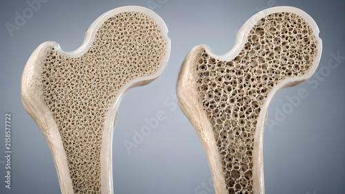 Osteopenia bone comparison medical illustration showing normal anatomy versus reduced trabecular density in a pre-osteoporosis concept for healthcare, radiology, medical and patient education