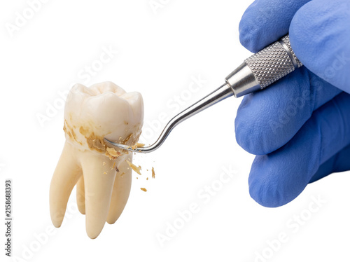 Dental plaque calculus removal human tooth model cleaned by dentist with dental scaler tool for hygiene medical concept closeup on black background showing tartar decay prevention care procedures.