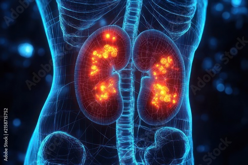 glowing inflamed kidneys inside a translucent blue torso wireframe with visible spinal column and pelvis, bright hotspots indicating pain and medical urgency