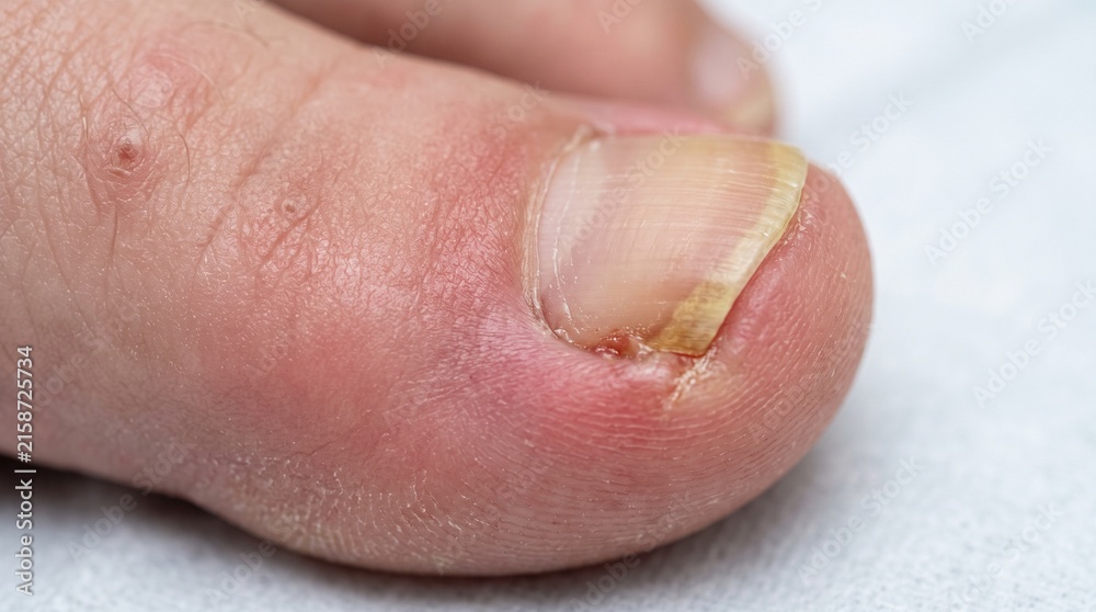Fototapeta premium Ingrown Nail