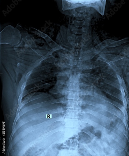 Photography Frontal AP view pelvis X-ray scan displaying hip joints and iliac bone structure