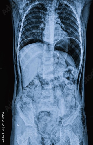 Bild auf Leinwand Frontal chest X-ray radiograph displaying lung fields rib cage and heart shadow