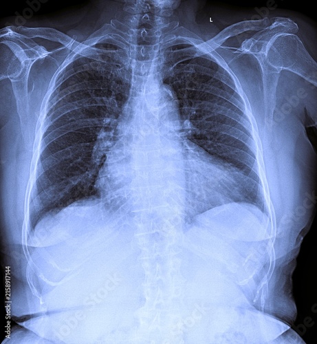 Foto Frontal chest X-ray radiograph displaying lung fields rib cage and heart shadow