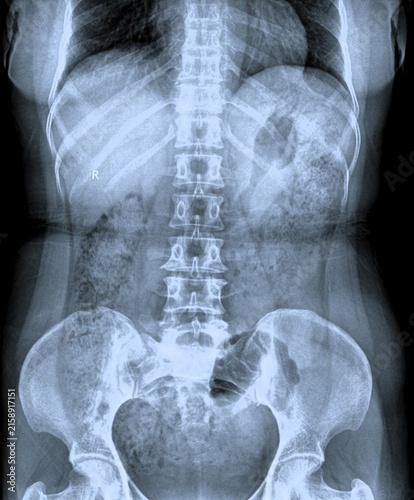 Foto Lumbar spine radiography AP and lateral view showing lumbar vertebrae and sacrum