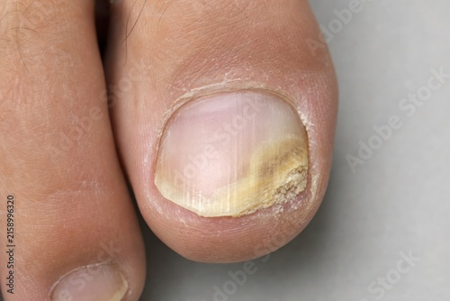 Thickened Yellow Great Toenail with Signs of Onychomycosis