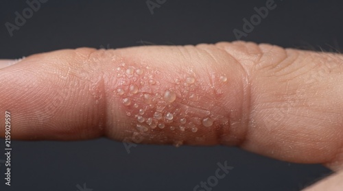 Macro shot of a finger afflicted with dyshidrotic eczema, pompholyx, showing small itchy clear blisters