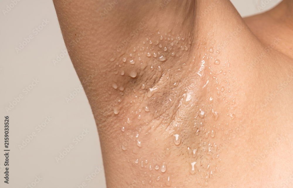 Fototapeta premium Close up of a human armpit heavily covered in sweat drops showing hyperhidrosis condition