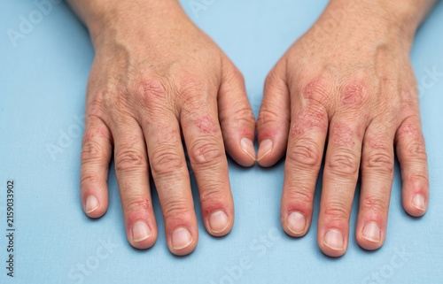 Close up of both hands suffering from severe eczema psoriasis and cracked scaly skin