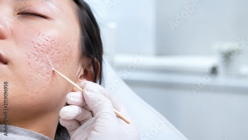 Close-up of professional facial skin treatment on woman with acne scar using wooden tool in clinic