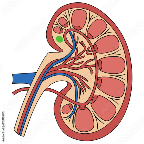 Kidney anatomy cross section with highlighted lesion vector graphic, internal