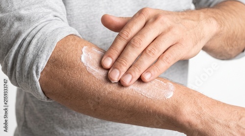 Man applying moisturizer cream to dry skin on his arm