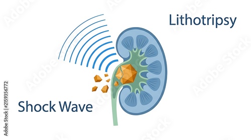 Shock wave lithotripsy procedure breaking kidney stone in human anatomy with calculus