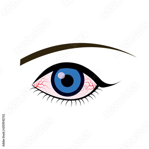 Illustration of the eye disease. conjunctivitis