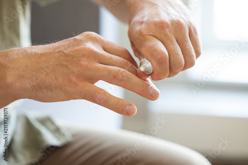 Man hand spreading healing dermatological cream on inflamed psoriasis fingers, dermatitis or skin dermatology disease. Home self care medical treatment.