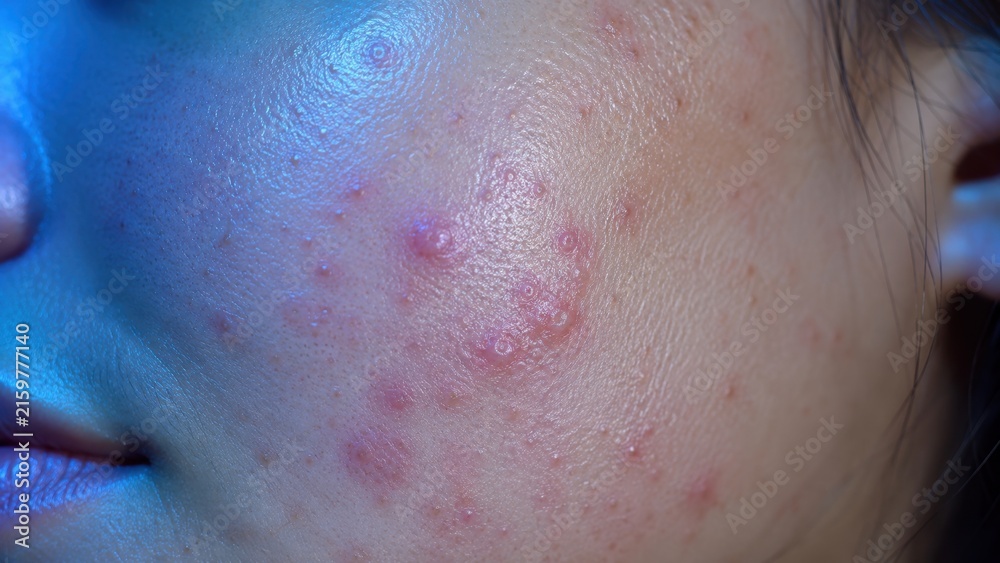 Fototapeta premium Close-up of young woman’s cheek with inflamed acne and red blemish skin condition on face