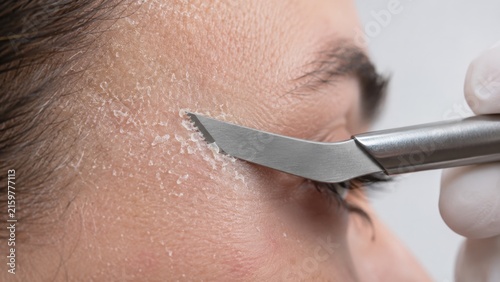 Close-up of facial skin exfoliation with a metallic dermaplaning tool by a gloved hand on cheek area