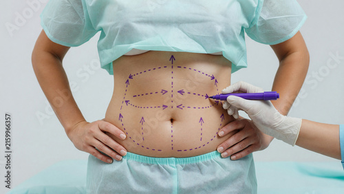 Plastic surgeon drawing surgical marking lines on patient abdomen, liposuction preparation and body contouring procedure