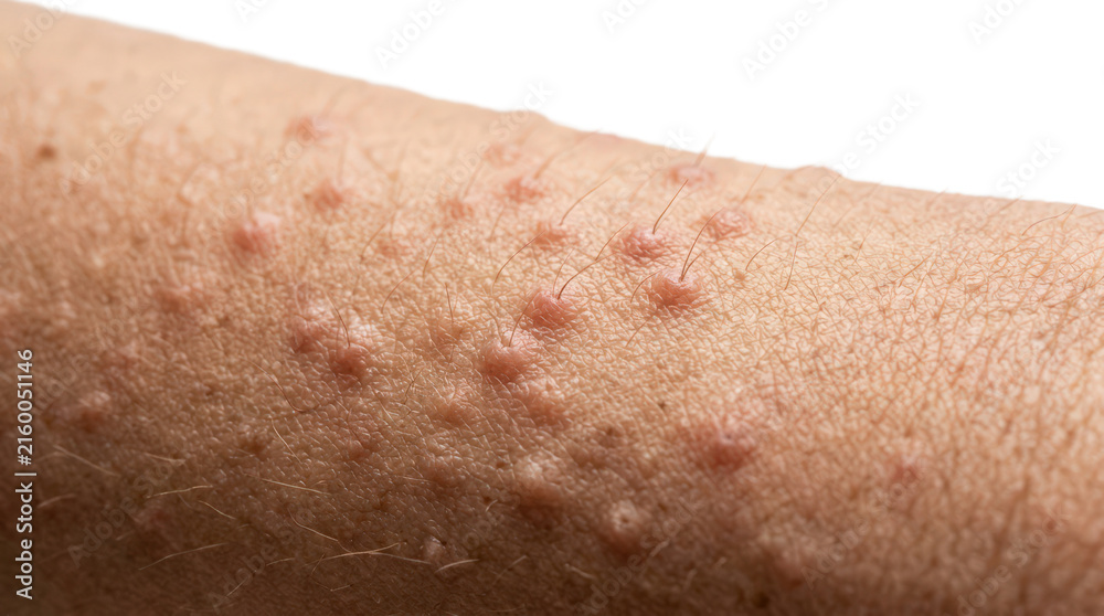 Fototapeta premium Closeup of keratosis pilaris on human arm skin isolated on transparent background