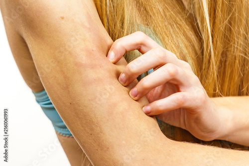 фотографія Woman scratching her itchy arm. Skin allergy.