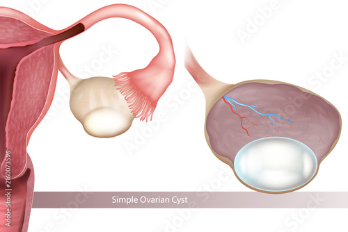 Cuadro en lienzo Medical illustration of a simple ovarian cyst showing a smooth, fluid-filled cyst arising from the ovary, with the uterus, fallopian tube, ovary, fimbriae and pelvic anatomy visible
