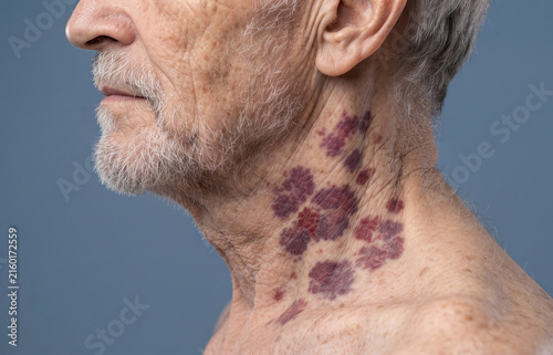Close Up of Severe Senile Purpura and Purple Vascular Lesions on Elderly Man Neck