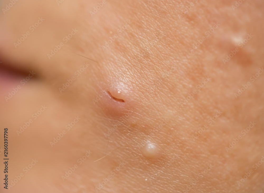Fototapeta premium Macro View of Skin Blemish and Clogged Pore on Human Face, concept of dermatological health and skin imperfections