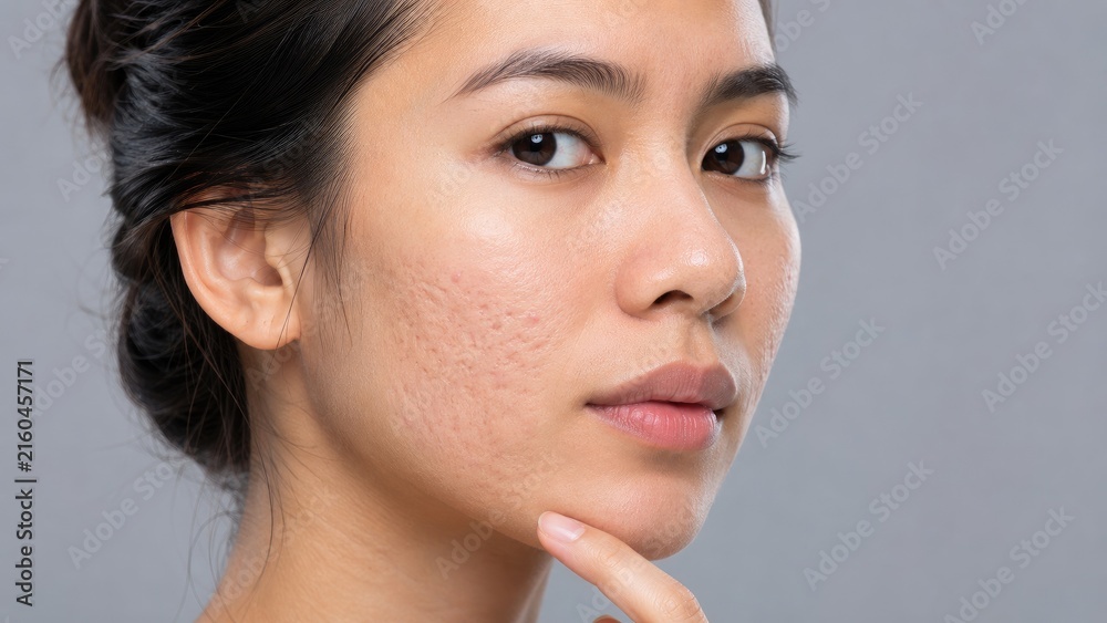 Obraz premium Close-up of young woman with facial acne scars touching her chin against a neutral gray background