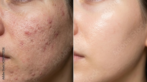 Woman showing skin transformation from acne to clear smooth surface