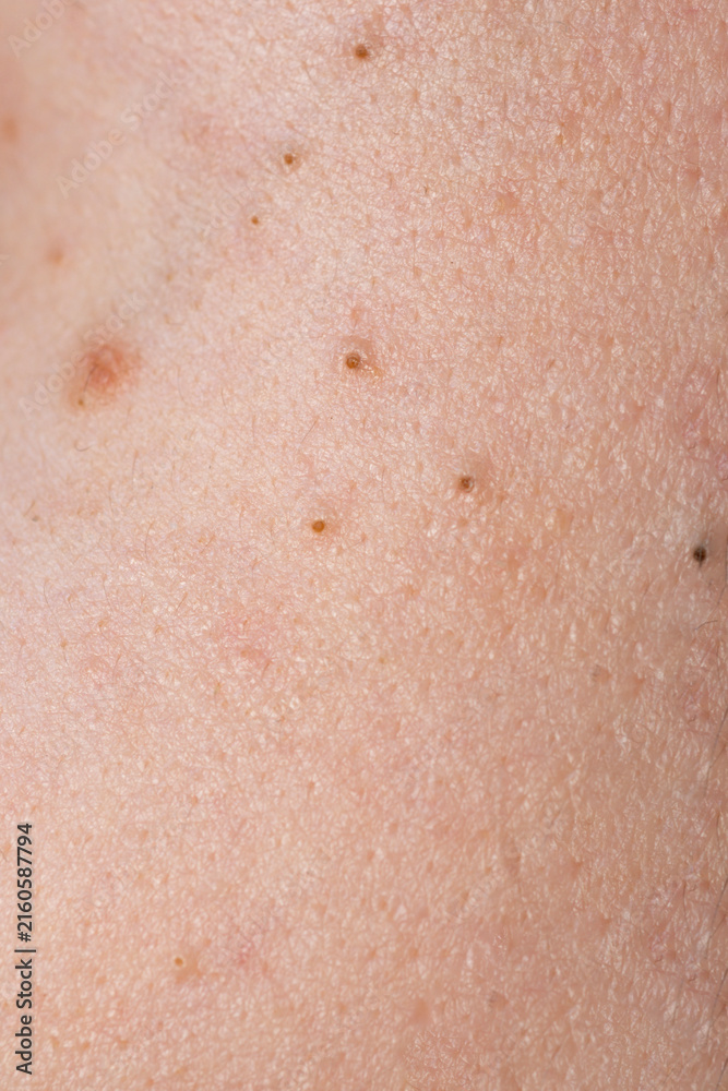 Fototapeta premium Close up acne on skin. Inflamed skin bumps acne macro. Irritated skin with pimples acne texture. Detailed skin with acne.
