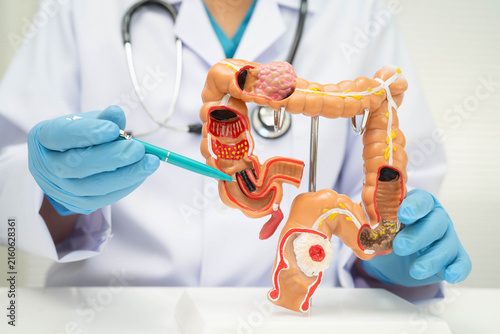 Colorectal cancer, doctor holding intestine colon human anatomy model.